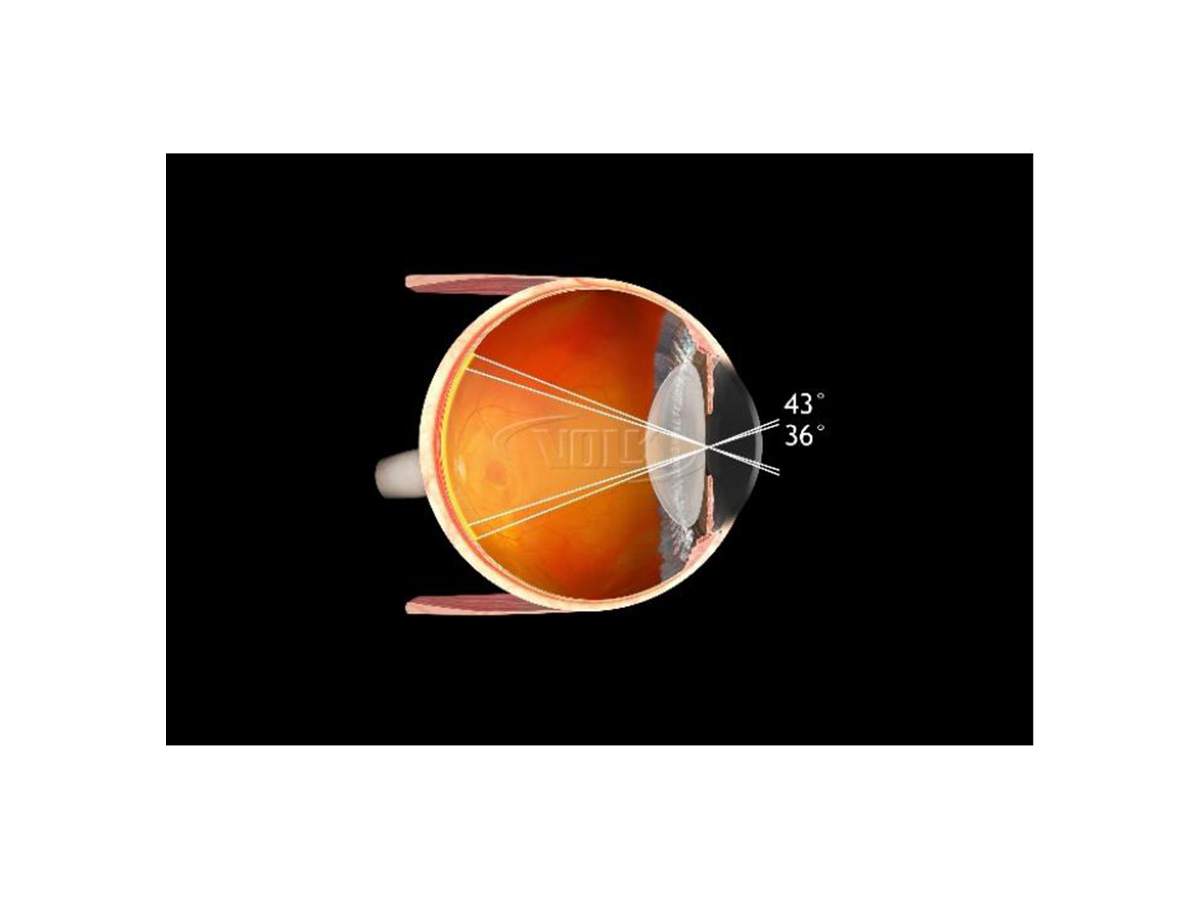 Volk Macula Plus 5.5 Ophthalmoskopierlupe – Bild 2