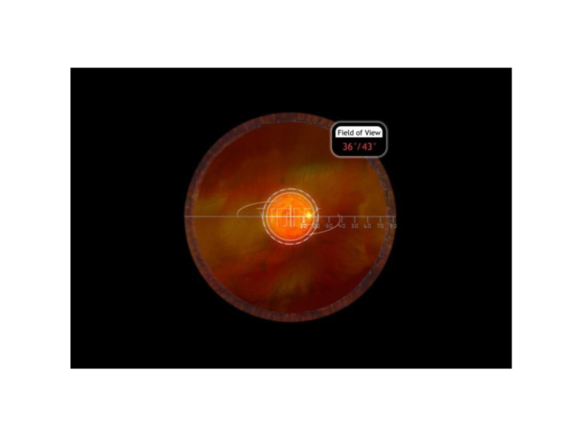 Volk Macula Plus 5.5 Ophthalmoskopierlupe – Bild 3